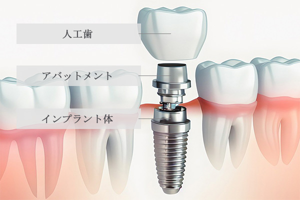 インプラントパーツ