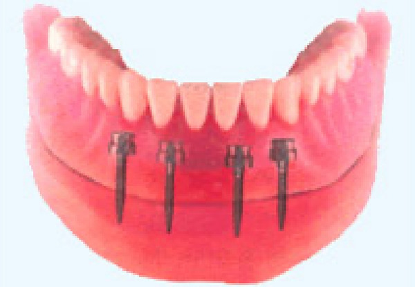 オーバーデンチャー