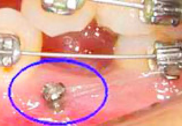 インプラント矯正