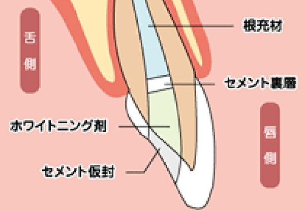 ウォーキングブリーチ