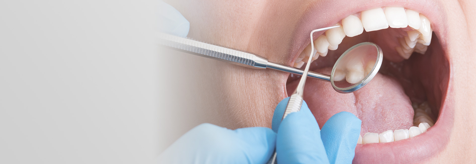 虫歯・歯周病治療 イメージ