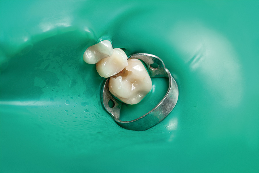 ラバーダム防湿の画像