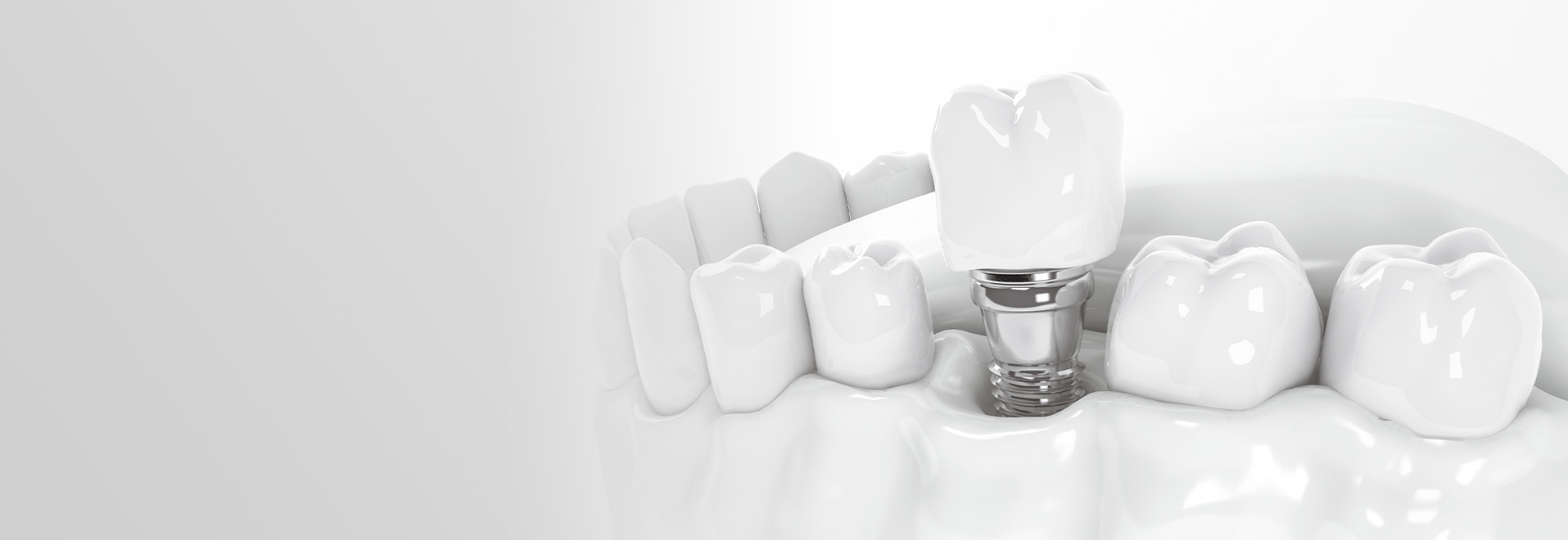 インプラント イメージ