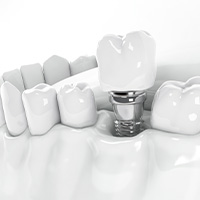 インプラントアイコン