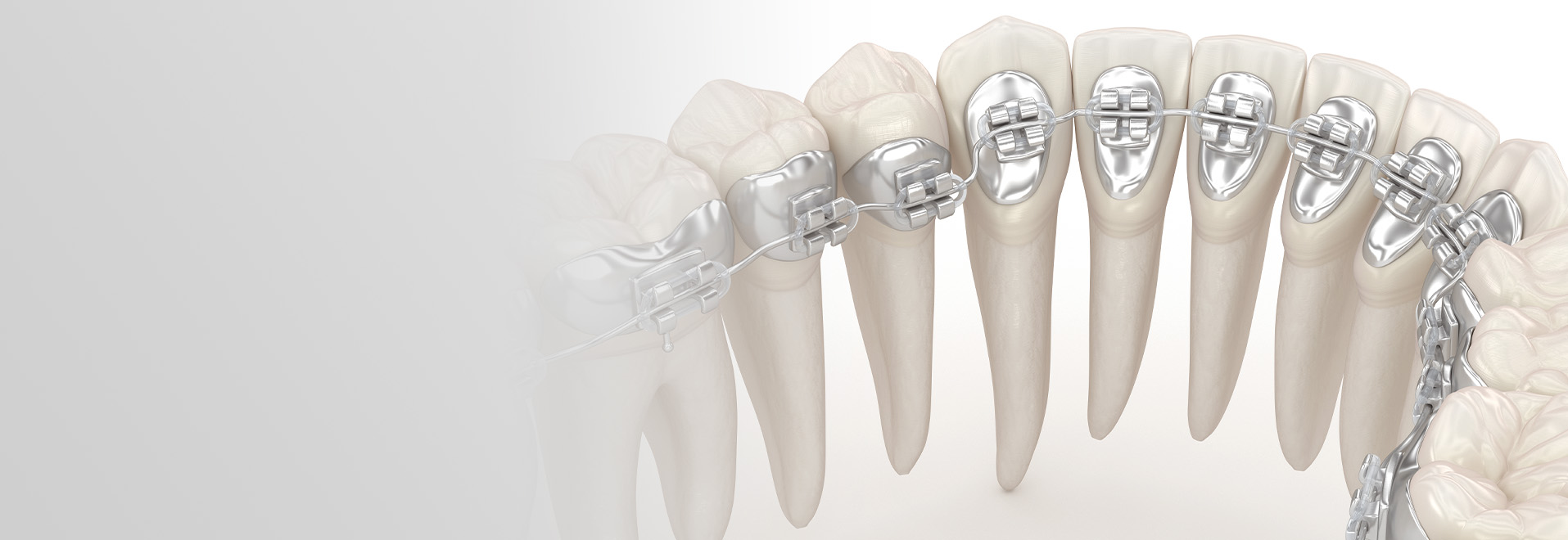 裏側矯正 イメージ
