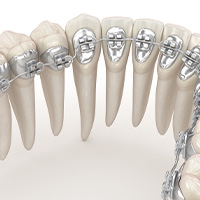 裏側矯正※リダイレクト用アイコン