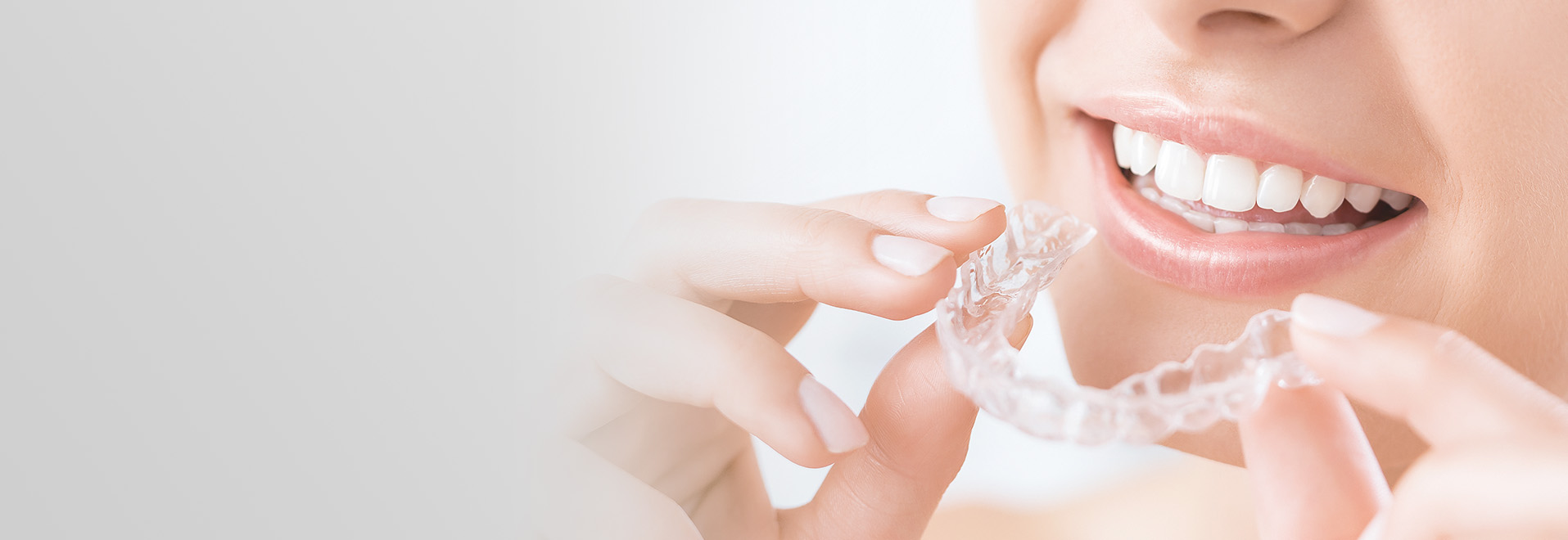 マウスピース矯正 イメージ