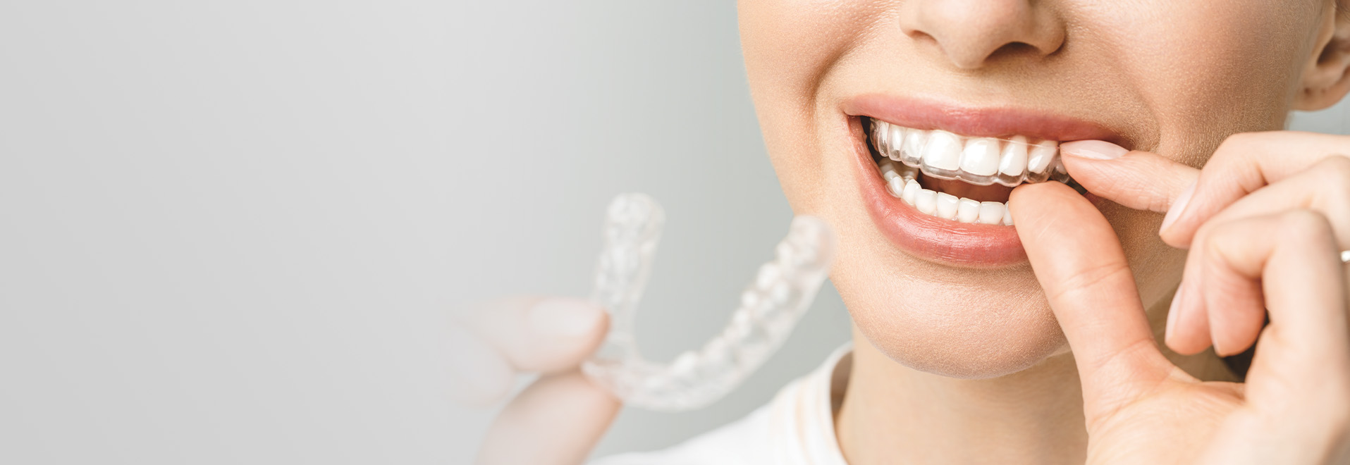 矯正歯科 イメージ